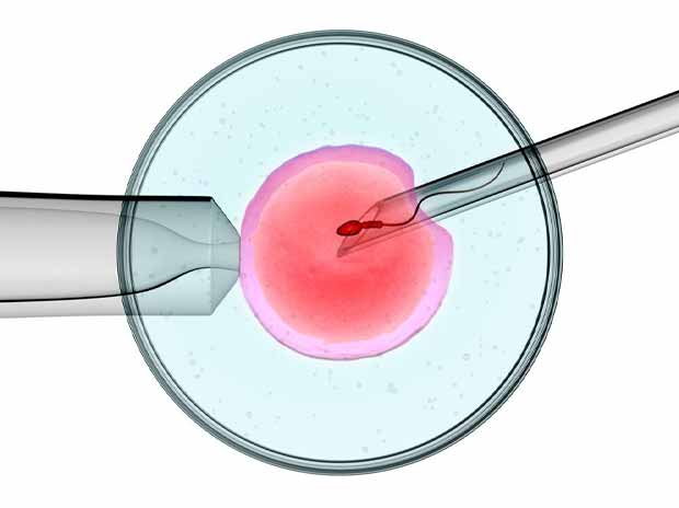 Intracytoplasmic sperm injection