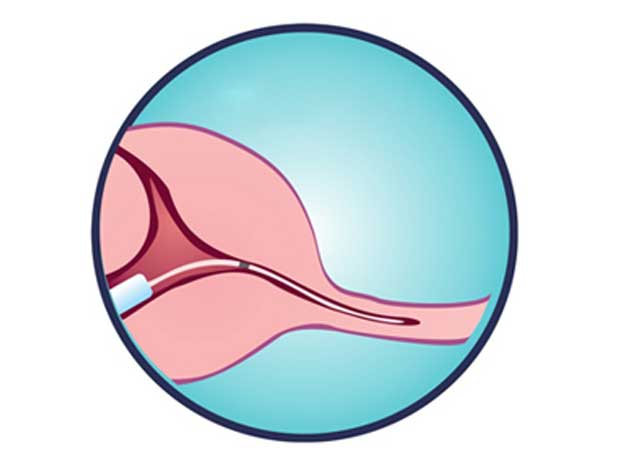 Fallopian Tube Cannulation Process